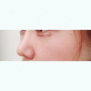 14日目の経過画像（2枚目）