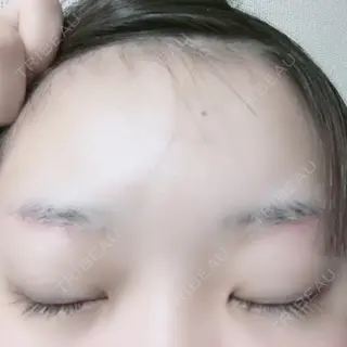13日目の経過画像（2枚目）