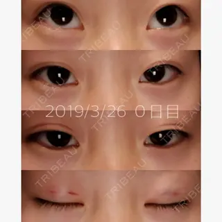 0日目の経過画像（1枚目）