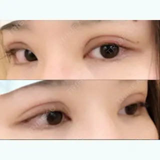 1日目の経過画像（2枚目）