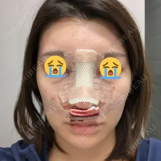 0日目の経過画像（1枚目）