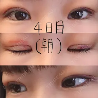 4日目の経過画像（1枚目）