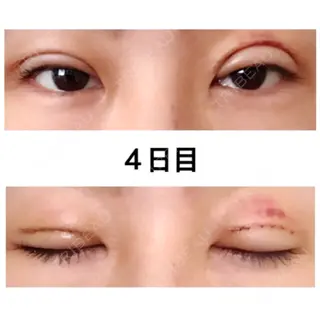 4日目の経過画像（1枚目）