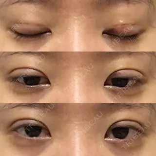 5日目の経過画像（1枚目）