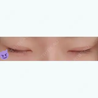29日目の経過画像（2枚目）