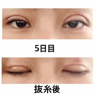 5日目の経過画像（1枚目）