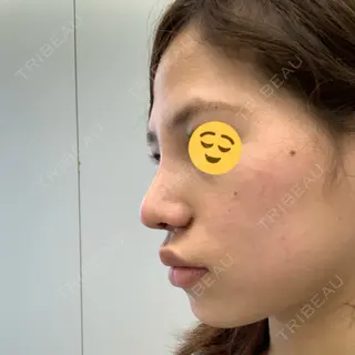 5日目の経過画像（2枚目）