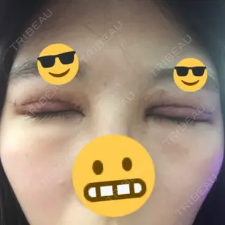 2日目の経過画像（2枚目）