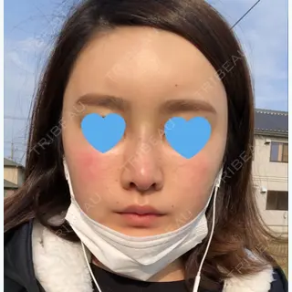9日目の経過画像（1枚目）
