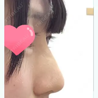 0日目の経過画像（2枚目）