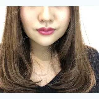 8日目の経過画像（1枚目）