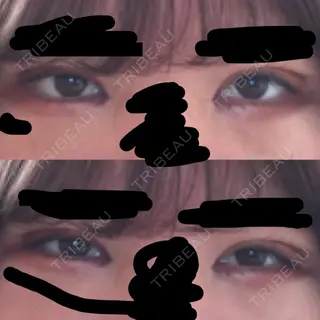 4日目の経過画像（1枚目）