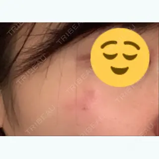 0日目の経過画像（2枚目）