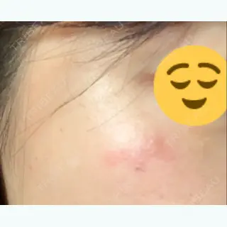 1日目の経過画像（2枚目）
