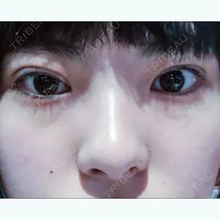5日目の経過画像（1枚目）