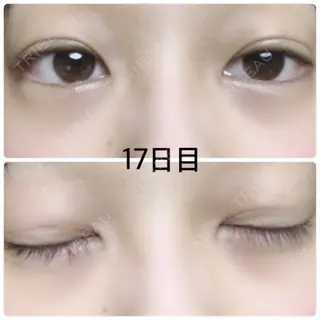 17日目の経過画像（1枚目）