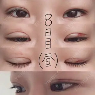8日目の経過画像（1枚目）