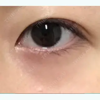 15日目の経過画像（3枚目）