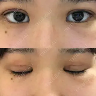2日目の経過画像（1枚目）