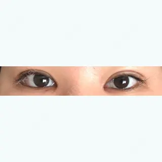 17日目の経過画像（1枚目）