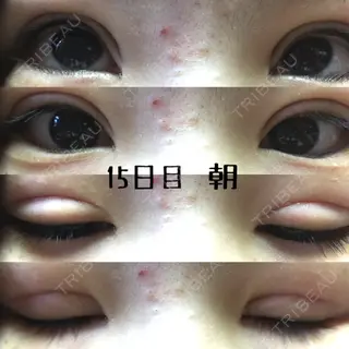 15日目の経過画像（1枚目）