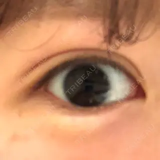 0日目の経過画像（2枚目）