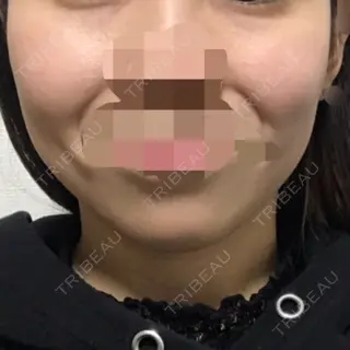 30日目の経過画像（2枚目）