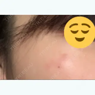 3日目の経過画像（2枚目）