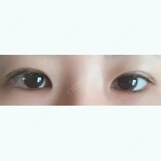 36日目の経過画像（1枚目）