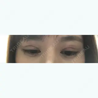 1日目の経過画像（2枚目）