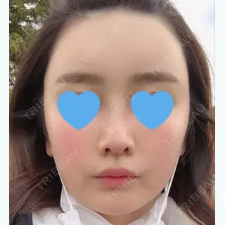 13日目の経過画像（1枚目）