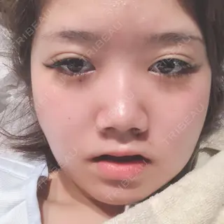 1日目の経過画像（1枚目）