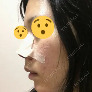 0日目の経過画像（3枚目）
