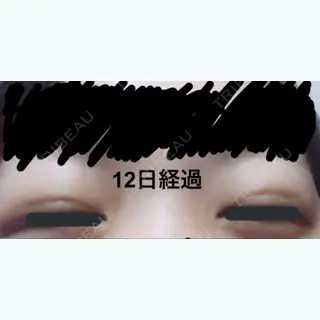 12日目の経過画像（2枚目）