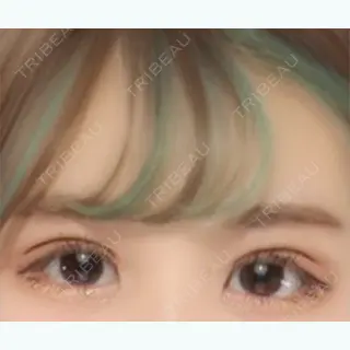 20日目の経過画像（3枚目）