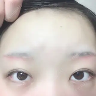 21日目の経過画像（1枚目）