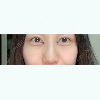 6日目の経過画像（1枚目）