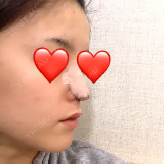 0日目の経過画像（2枚目）