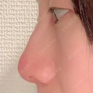44日目の経過画像（2枚目）
