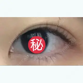 61日目の経過画像（2枚目）