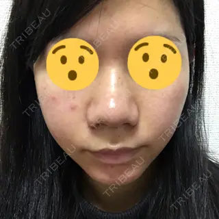 3日目の経過画像（1枚目）