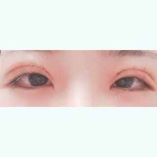 2日目の経過画像（1枚目）
