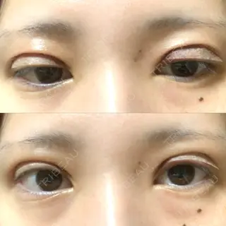0日目の経過画像（1枚目）