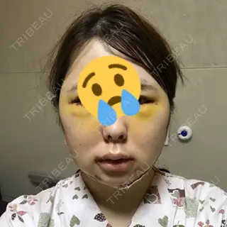 4日目の経過画像（1枚目）