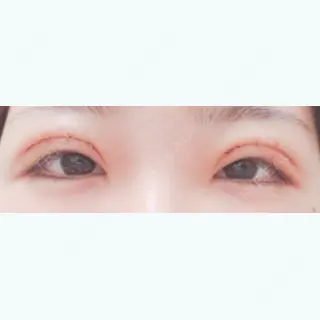 3日目の経過画像（1枚目）
