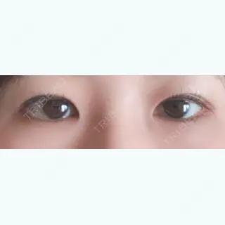 40日目の経過画像（3枚目）