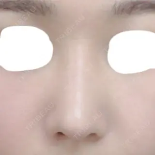28日目の経過画像（1枚目）