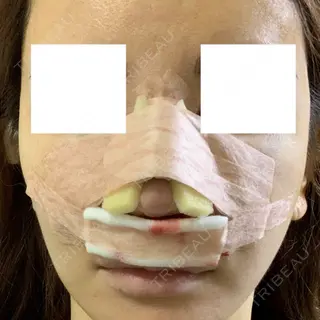 0日目の経過画像（2枚目）