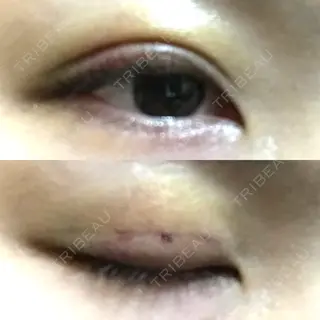 3日目の経過画像（1枚目）