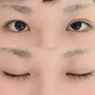 45日目の経過画像（1枚目）